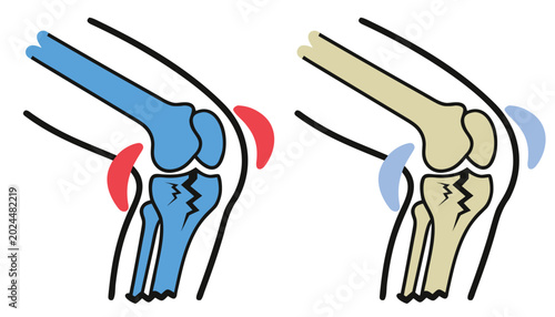 Tableau sur toile Conceptual illustration of two knees, one healthy with intact bone structure and cartilage, another with a cracked bone