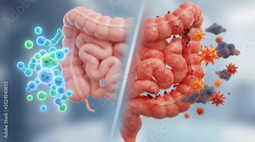 Healthy gut vs inflamed gut comparison shows difference between normal digestive system and damaged intestine with harmful bacteria and inflammation effects