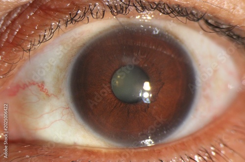 Tableau sur toile Clinical anterior segment image demonstrating a cataract