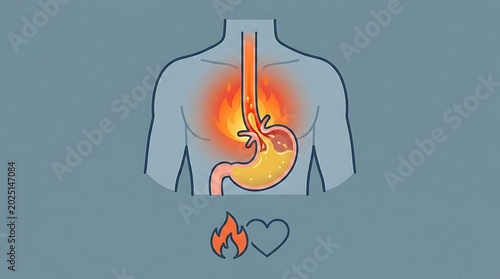 Medical Illustration of Gastroesophageal Reflux Disease GERD Showing Open Lower Esophageal Sphincter with Inflamed Esophagus Anatomy Depicting Chronic Heartburn Acid Regurgitation and Chest Pain