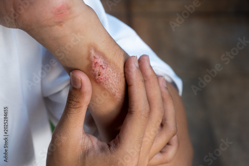 A man suffering from first-degree burn wound on his left hand, his other hand holding the area near the wound