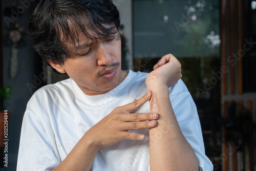 A Southeast Asian man suffering from first-degree burn wound on his left hand, his other hand holding the area near the wound