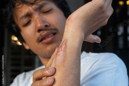 A Southeast Asian man suffering from first-degree burn wound on his left hand, his other hand holding the area near the wound