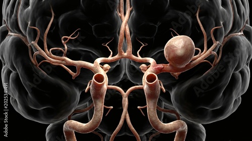 Anatomical illustration of a brain with a cerebral aneurysm on a blood vessel