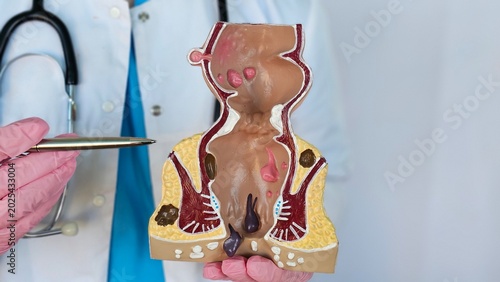 Photos Doctor with model of human rectal anatomy and hemorrhoids in hospital, inflamed