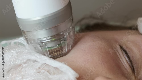 Close-up of a cosmetic microneedling procedure on a woman’s face in a beauty clinic. A professional skincare device is applied to the cheek area to improve skin texture, stimulate collagen production,