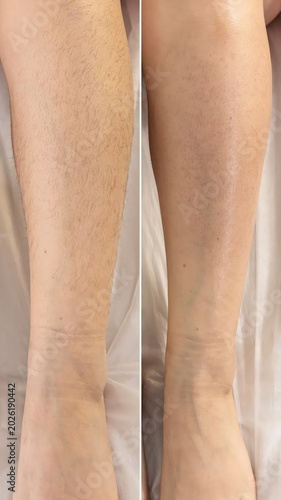 Collage of woman showing leg before and after waxing depilation. Hair Removal epilation procedures result
