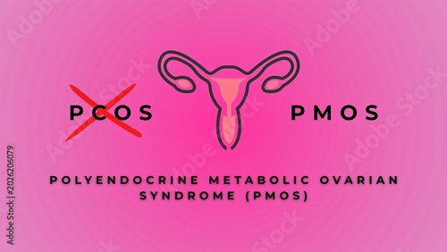 Tableau sur toile PCOS is now officially PMOS