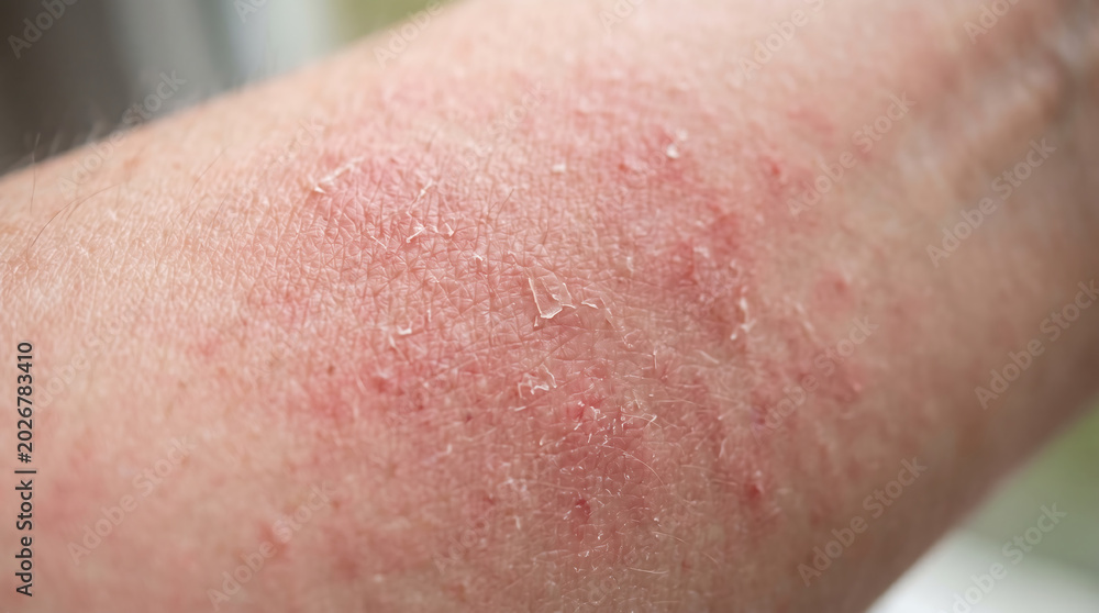 Fototapeta premium Allergic skin rash close up with red bumps and itchy eczema texture on adult arm for dermatological medical treatment and sensitive skin care ad.