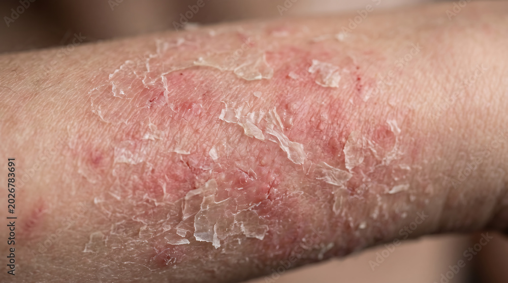 Fototapeta premium Severe eczema rash on patient arm with red inflamed skin allergy, flaking skin peeling and atopic dermatitis dermatological close up texture.