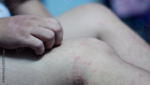 Canvastavla Close up itchy rash, red bumps, irritated skin representing cholinergic urticaria, allergic reaction, skin inflammation, dermatology problem, immunity response, healthcare condition