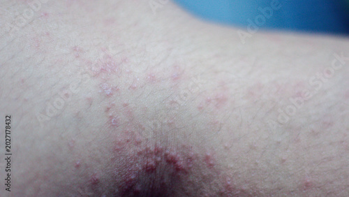 Konstfotografi Close up itchy rash, red bumps, irritated skin representing cholinergic urticaria, allergic reaction, skin inflammation, dermatology problem, immunity response, healthcare condition