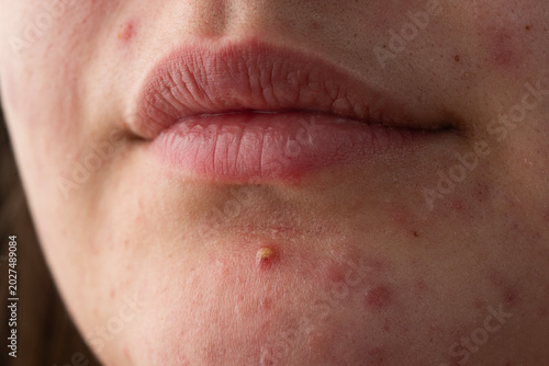 Quadro em tela Macro shot of skin irritation with acne