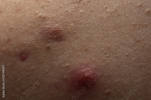 Quadro em tela Acne skin pimple