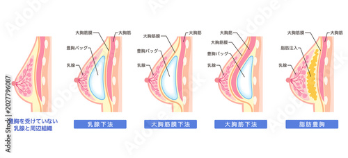 豊胸手術の種類　構造　豊胸