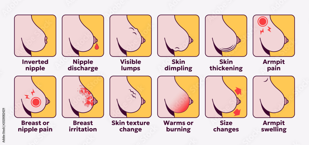 Fototapeta premium Breast cancer symptoms icon set. Female medical signs for breast health awareness, diagnosis and healthcare. Vector illustration for education and medical concepts.