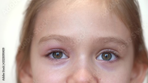 Close up of puffy child eye with barley. Insect bite allergy. Swelling eyelid. Conjunctivitis. Allergy. Medicine and health care