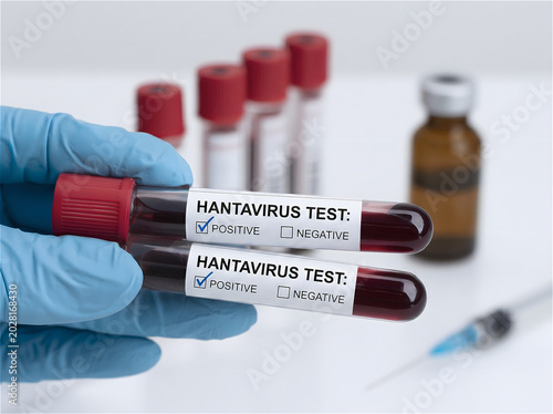 Laboratory scientist holding two positive hantavirus blood test tubes in blue gloves, infectious disease outbreak diagnostic concept