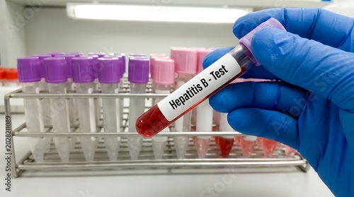 Doctor holding test tube with hepatitis b blood sample in laboratory rack