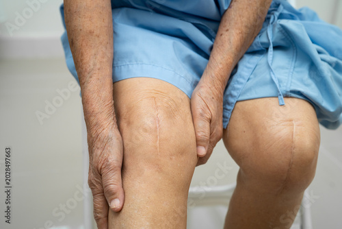 Asian elderly woman patient with scar knee replacement surgery in hospital.