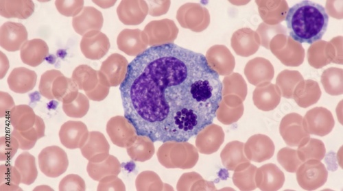 Ehrlichia Chaffeensis Morulae Monocyte Blood Smear Giemsa. Ehrlichia chaffeensis morulae within monocyte cytoplasm in Giemsa stained peripheral blood smear from ehrlichiosis case.