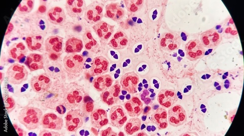 Streptococcus Pneumoniae Lancet Diplococci Gram Stain. Gram positive lancet-shaped diplococci with surrounding capsule halo in Gram stained sputum smear from pneumonia case.