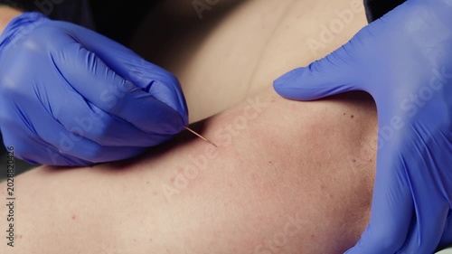 Chinese acupuncture needles, Adult male physiotherapist is doing acupuncture on the body back of a male patient. Patient is lying down on a bed, chinese sport medicine.