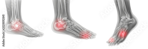 Tableau sur toile Foot Pain X-Ray PNG Set, Inflamed Joints and Bones Illustration, Gout and Arthri