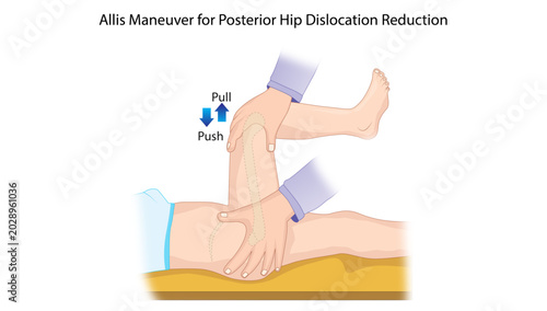 Photos Allis Maneuver for Posterior Hip Dislocation Reduction
Orthopedic illustration demonstrating the Allis maneuver technique used for closed reduction of posterior hip dislocation with traction
