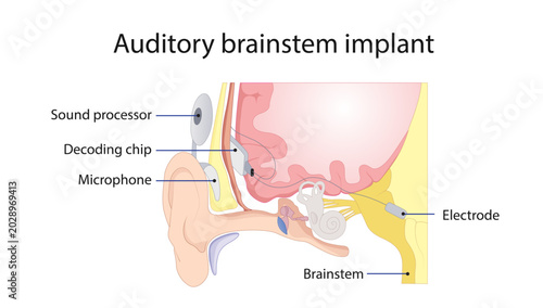 Cuadro en lienzo Auditory Brainstem Implant
Medical illustration showing the components and placement of an auditory brainstem implant used for hearing rehabilitation in patients with cochlear nerve disorders