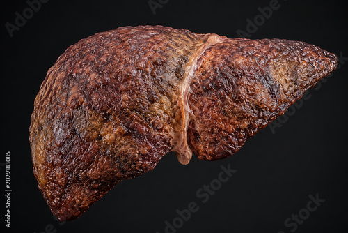 Advanced Liver Fibrosis from Fatty Liver