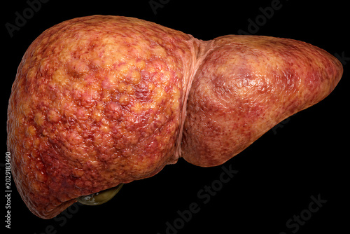 Severe Fatty Liver with Inflammation