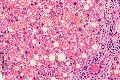 Mild Fatty Liver Close-Up