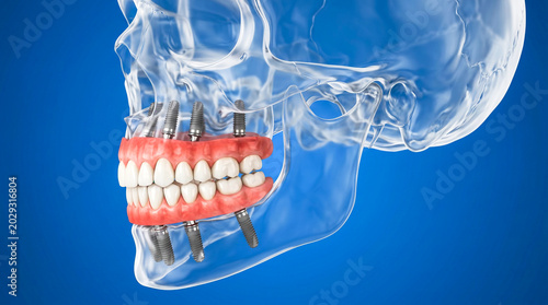 Transparent skull showing dental implants and prosthetic