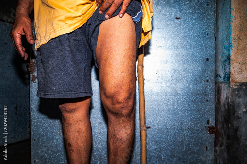 Photography Osteoarthritis is a degenerative joint disease characterized by the wearing down of protective cartilage, causing joint pain and stiffness, and decreased ability to move freely