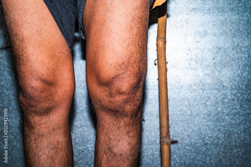 Canvas Print Osteoarthritis is a degenerative joint disease characterized by the wearing down of protective cartilage, causing joint pain and stiffness, and decreased ability to move freely