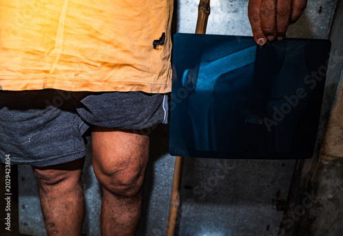 Photography Osteoarthritis is a degenerative joint disease characterized by the wearing down of protective cartilage, causing joint pain and stiffness, and decreased ability to move freely