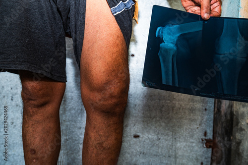 Photography Osteoarthritis is a degenerative joint disease characterized by the wearing down of protective cartilage, causing joint pain and stiffness, and decreased ability to move freely