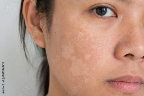 Close Up of Vitiligo White Patches and Uneven Skin Pigmentation on Female Face