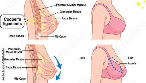 Foto Female Breast Anatomy Diagram Vector Set Showing Sagging Cooper Ligaments Aging