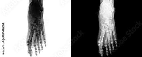 Bild auf Leinwand Medical Foot Anterior View X-ray Image Showing Clear Visualization of Tarsal and