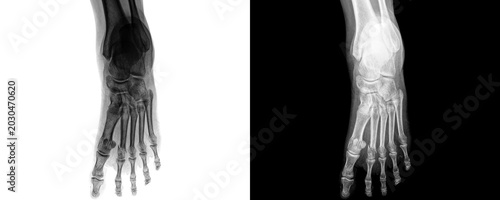 Bild auf Leinwand Clinical Foot Anterior Projection X-ray Radiograph Illustrating Bone Alignment f