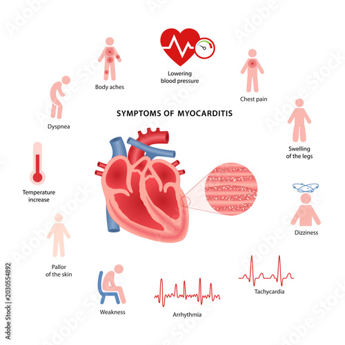 Photos Symptoms of myocarditis