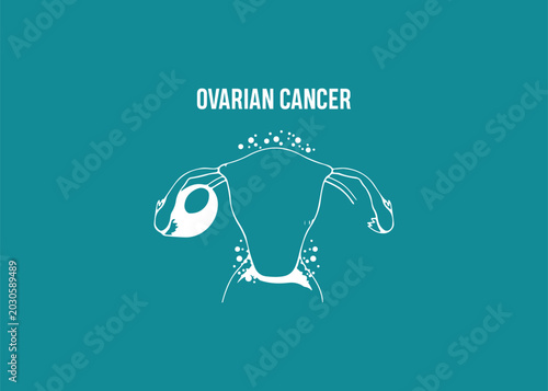 Medical illustration depicting ovarian cancer with malignant growth and cellular spread, metastasis