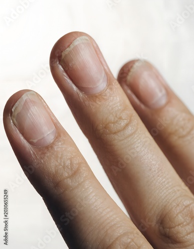 Natural Brittle Nails and Dry Cuticles Macro Close Up