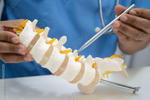 Asian doctor holding spinal nerve and bone model, Lumbar spine displaced herniated disc fragment for treatment medical in the orthopedic department.