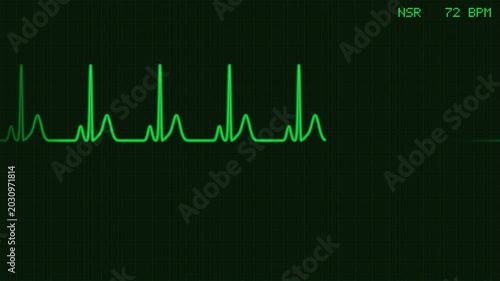 Animated EKG monitor transitioning from normal sinus rhythm to ventricular fibrillation v-fib with flashing alert