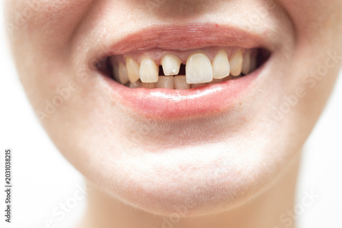 an abutment for a young woman's central tooth implant