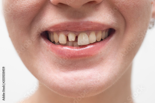 young woman dental implant healing abutment in gum