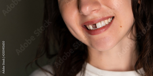 Foto Emotional woman shows smile and missing front tooth due to dental issue while st